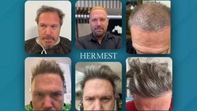 Hair Transplants in Turkey